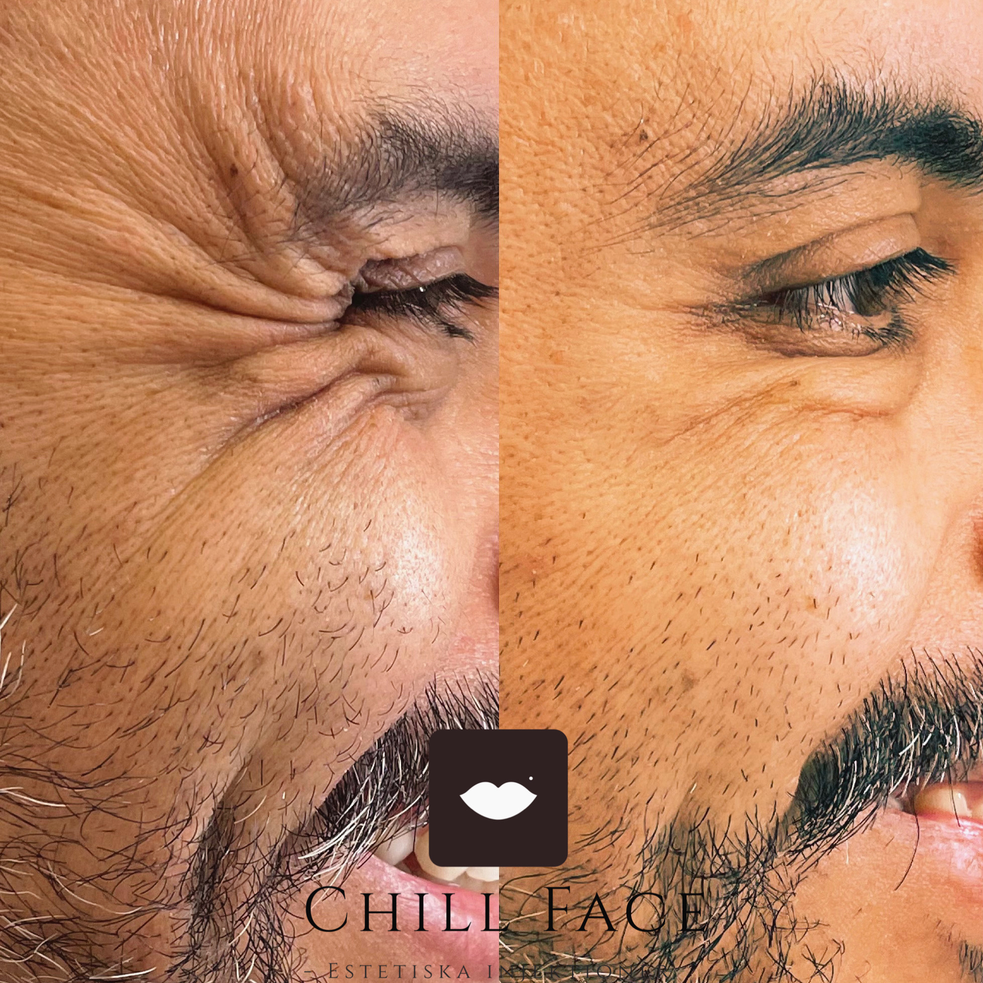 Chill Face- Estetiska injektioner, Gävle - Bokadirekt