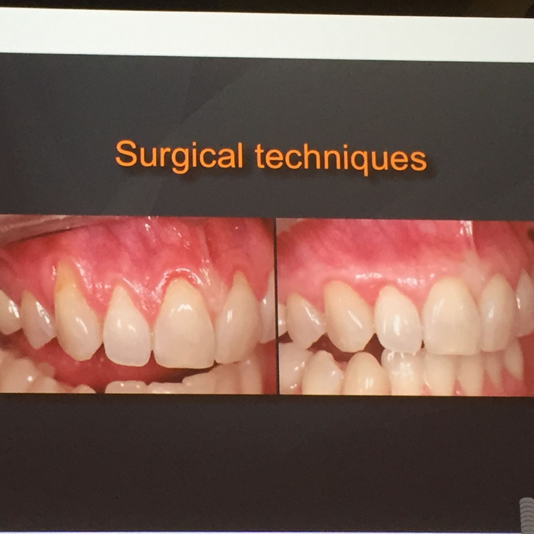 Kista Nasolabial Nasoalveolar Dan Perawatannya